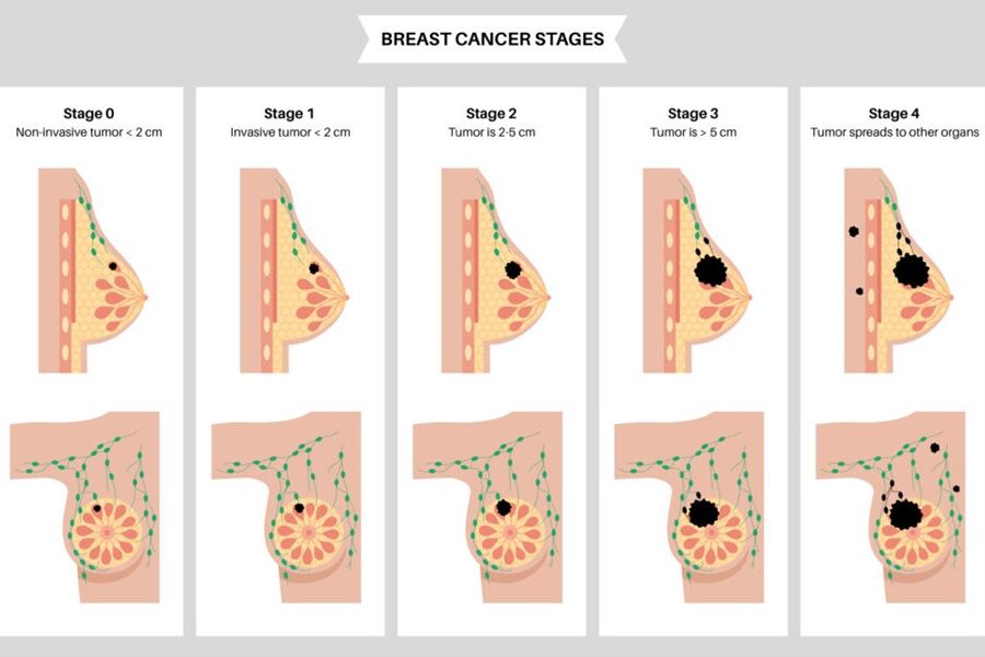 유방암1 유방암1